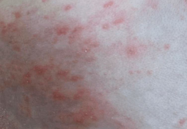 피부에-오돌토돌-올라온-땀띠