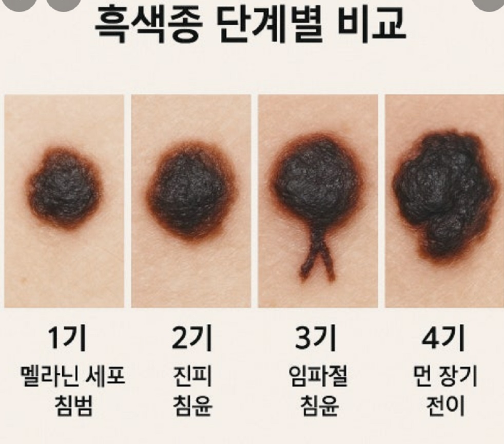 흑색종-단계별-비교