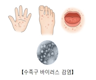 수족구 증상 5가지 | 수족구 잠복기 초기 수포 전염성