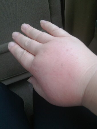 오른-손등에-벌침을-여러방-쏘여-빨갛게-부어오르고-풍선손처럼-완전히-부어올라-병원에-빨리-후송해야하는-모습