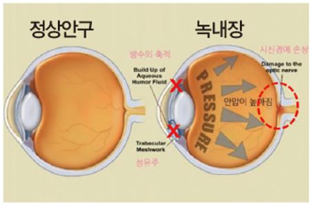 녹내장