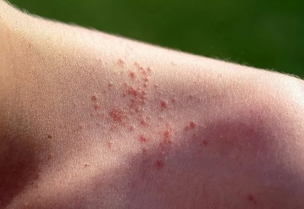 땀띠 자주 묻는 질문 FAQ