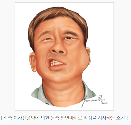 설암 침샘암 편도암 초기증상