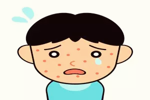 두드러기-가라앉히는법