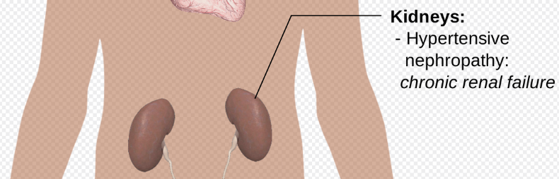 신장암 초기증상 5가지