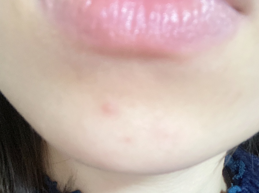 스킨보톡스 후기