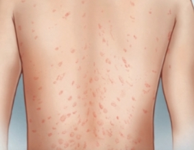 장미빛 비강진 원인