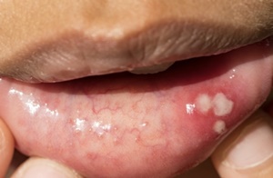 구내염 빨리 낫는 법