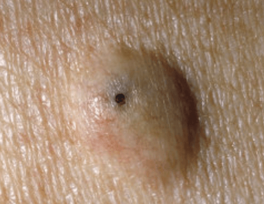 표피(피지) 낭종