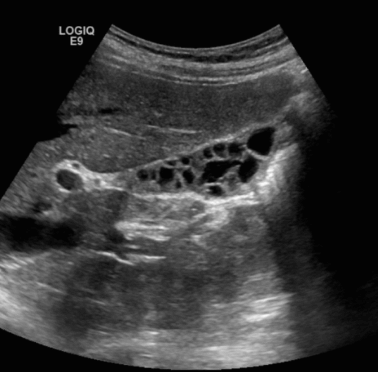 담낭의 정상변이 (normla variation)