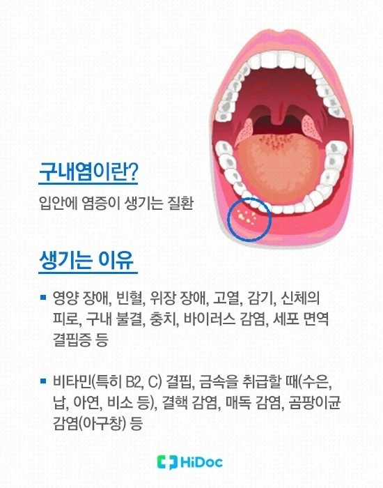 구내염 생기는 이유