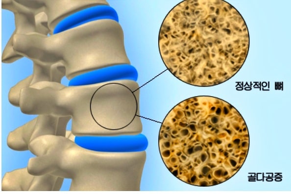 골다공증 증상