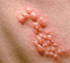 대상포진 초기증상 10가지