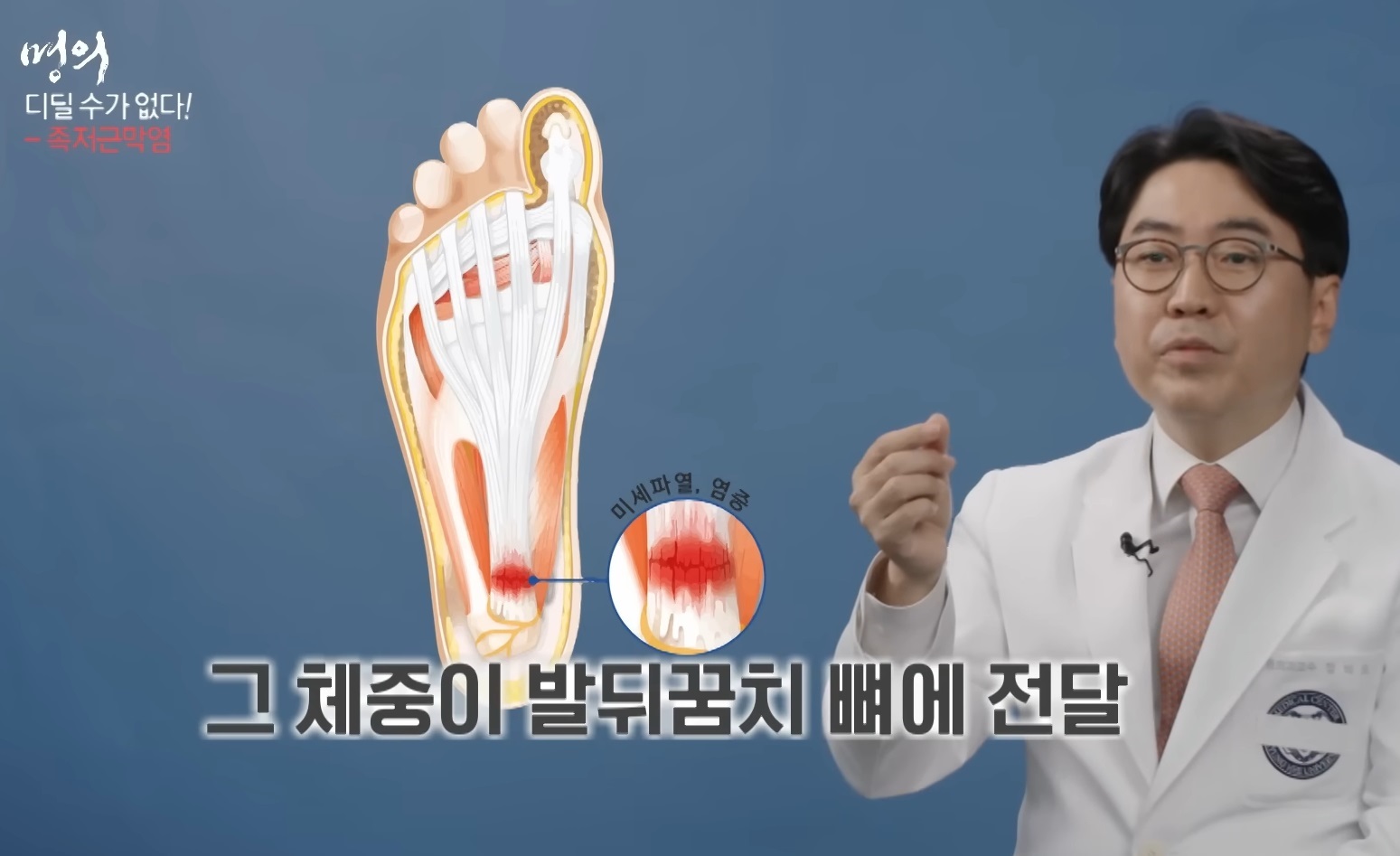 족저근막염-명의-최기원-교수
