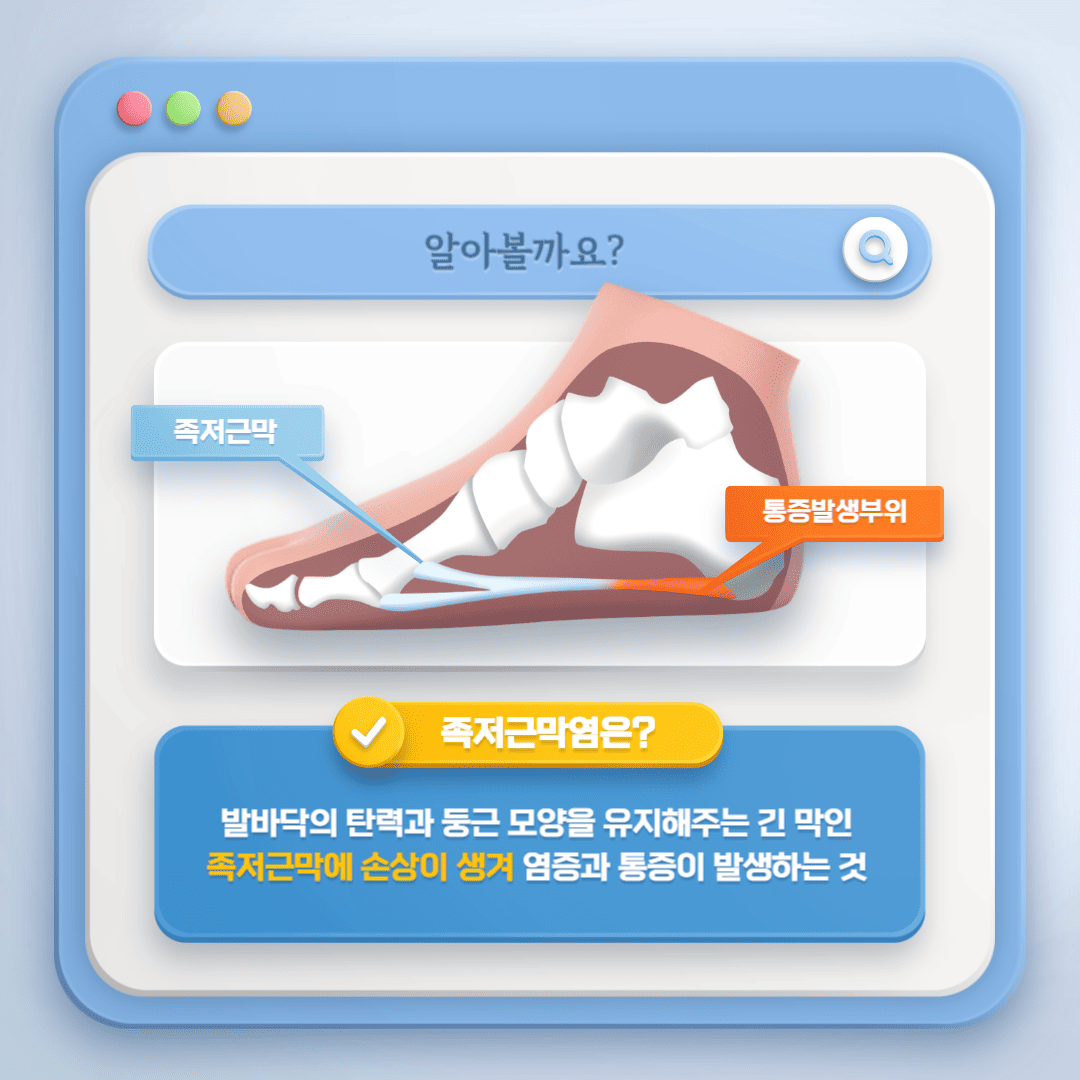 족저근막염 안내그림