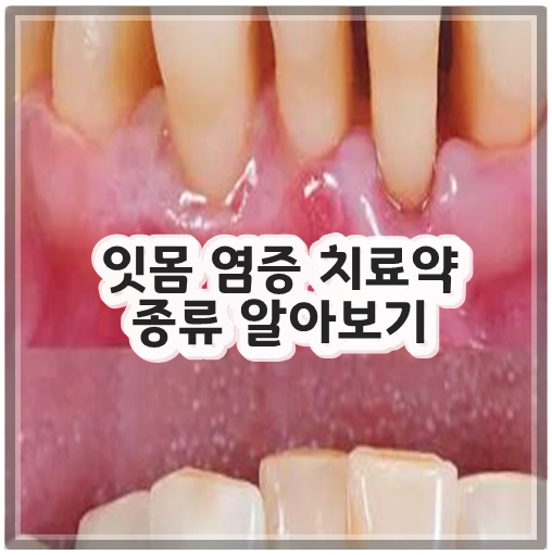 잇몸 염증 치료약 종류 알아보기