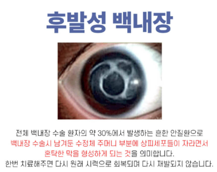 후발성 백내장
