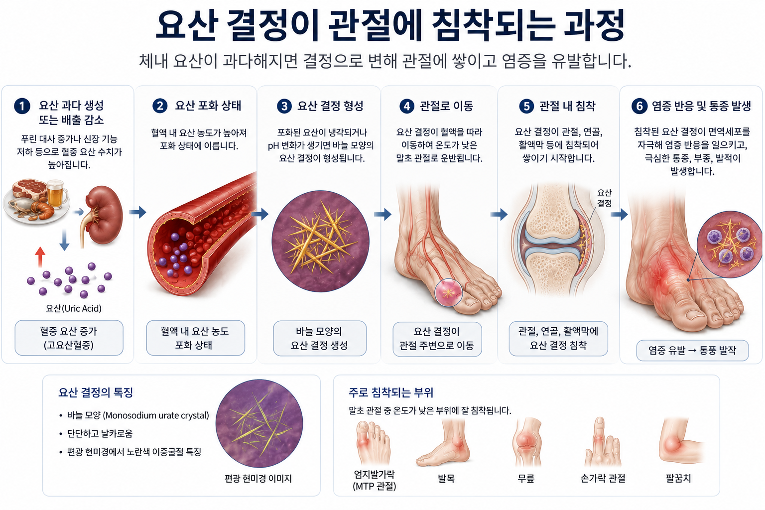요산 수치 높으면 통풍 위험할까?