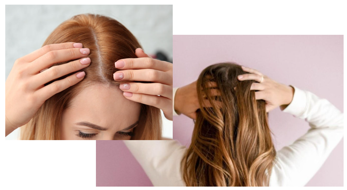 여자 정수리 탈모 원인