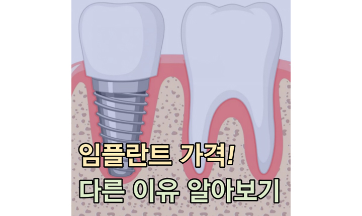 임플란트 가격 다른 이유 썸네일