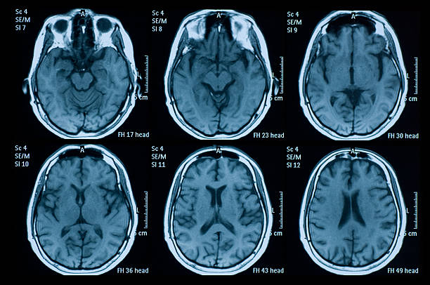 MRI1