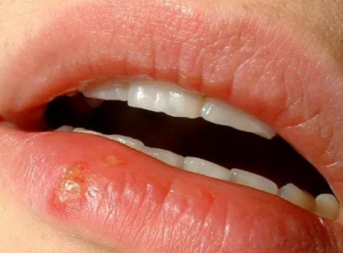 입술에 물집이 생기는 이유