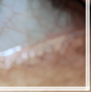 백내장 초기 증상