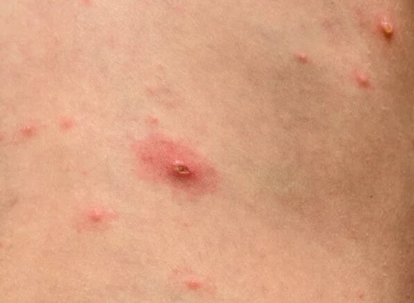 대상포진 초기증상 대상포진 조기치료 대상포진 초기증상 및 조기치료