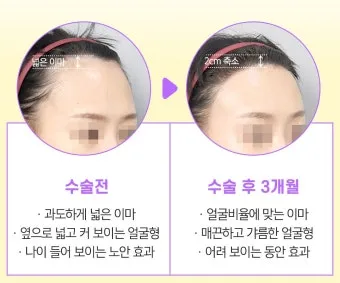 이마가 넓은 여자 관상 특징과 해석_2