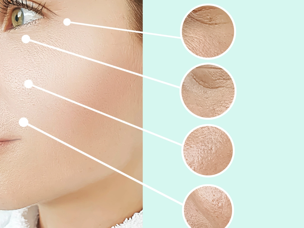 피부 주름 개선