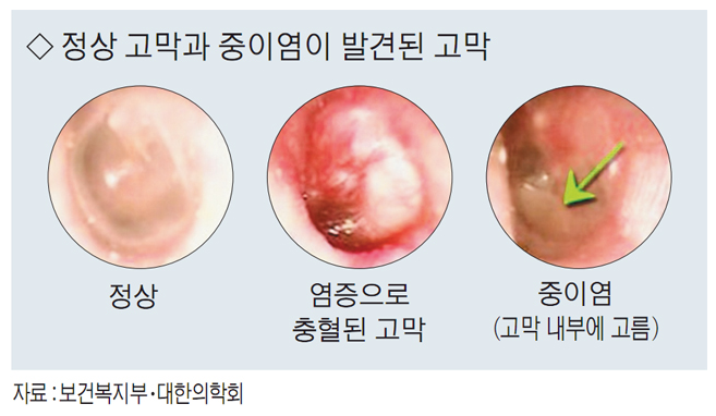 정상고막과 중이염 고막 비교사진