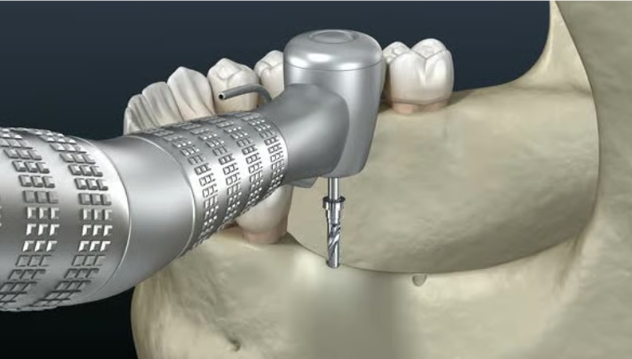 뼈이식 시술 과정