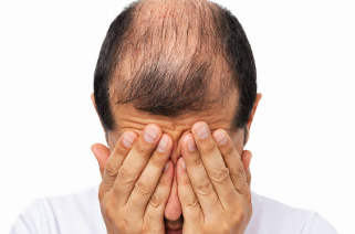 탈모
