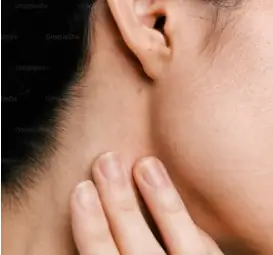 검버섯 레이저 치료 비용