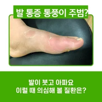 발가락 통풍 증상 및 대처방법_10