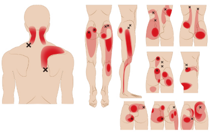 모든 근육을 감싸고 있는 근막에 통증을 유발점이 발생하여 통증이 나타난다.