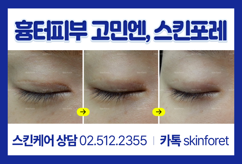 눈이 덜 감기는 증상과 쌍꺼풀 재수술 전후 관리 모습