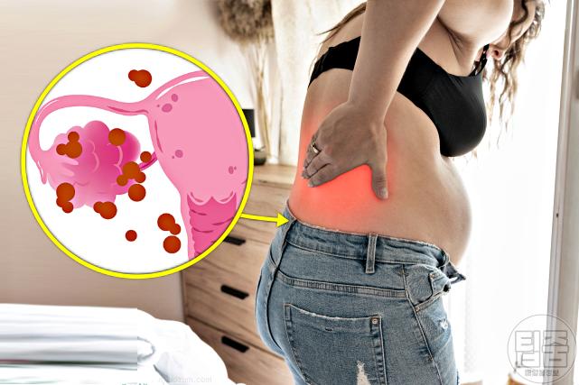 난소암 증상 전조증상 허리통증