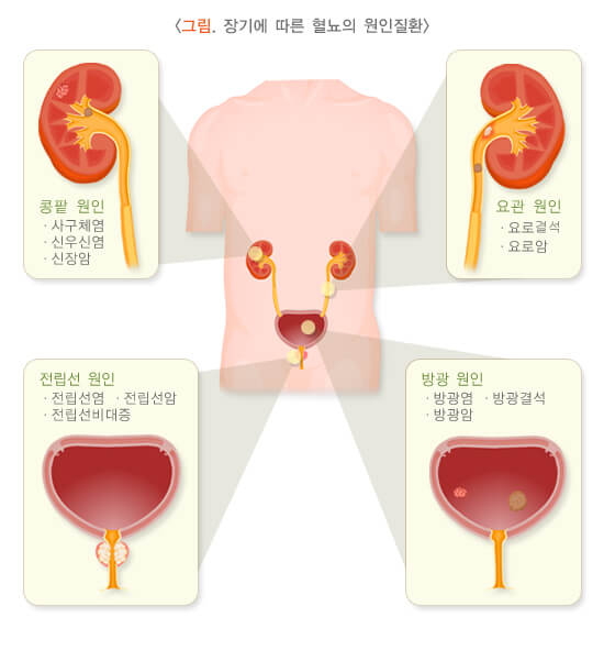 혈뇨