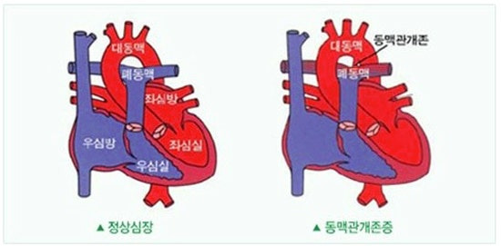 동맥관 개존증