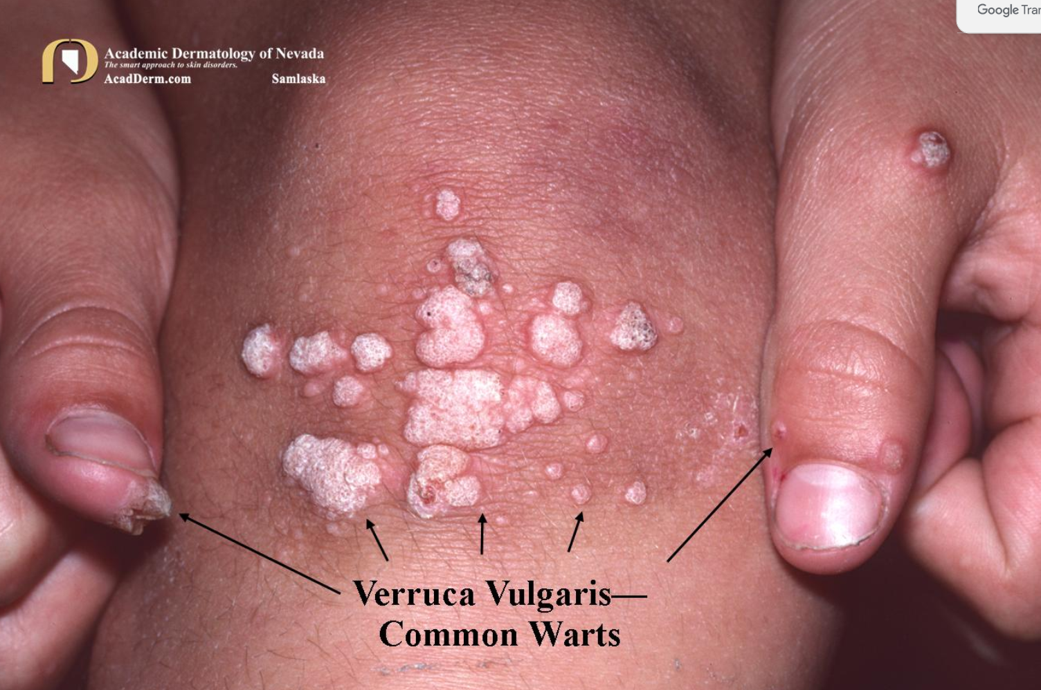 편평사마귀 원인&amp;#44; 증상&amp;#44; 치료 및 주의사항
