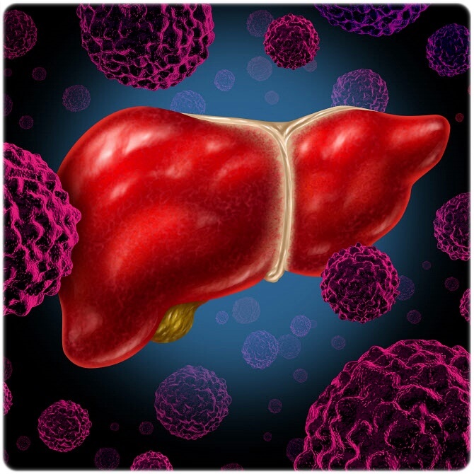 간암 초기증상 원인 진단 치료 예방 생존율