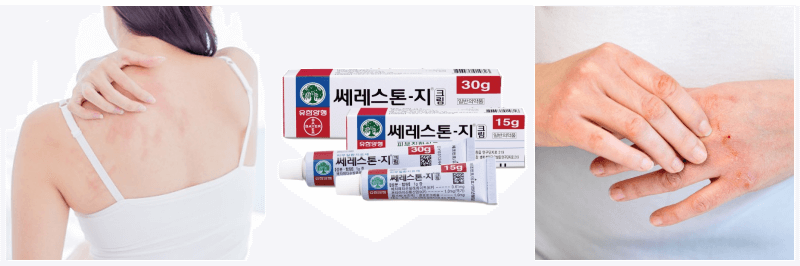 가려움증&#44; 쎄레스톤지 크림&#44; 습진 사진