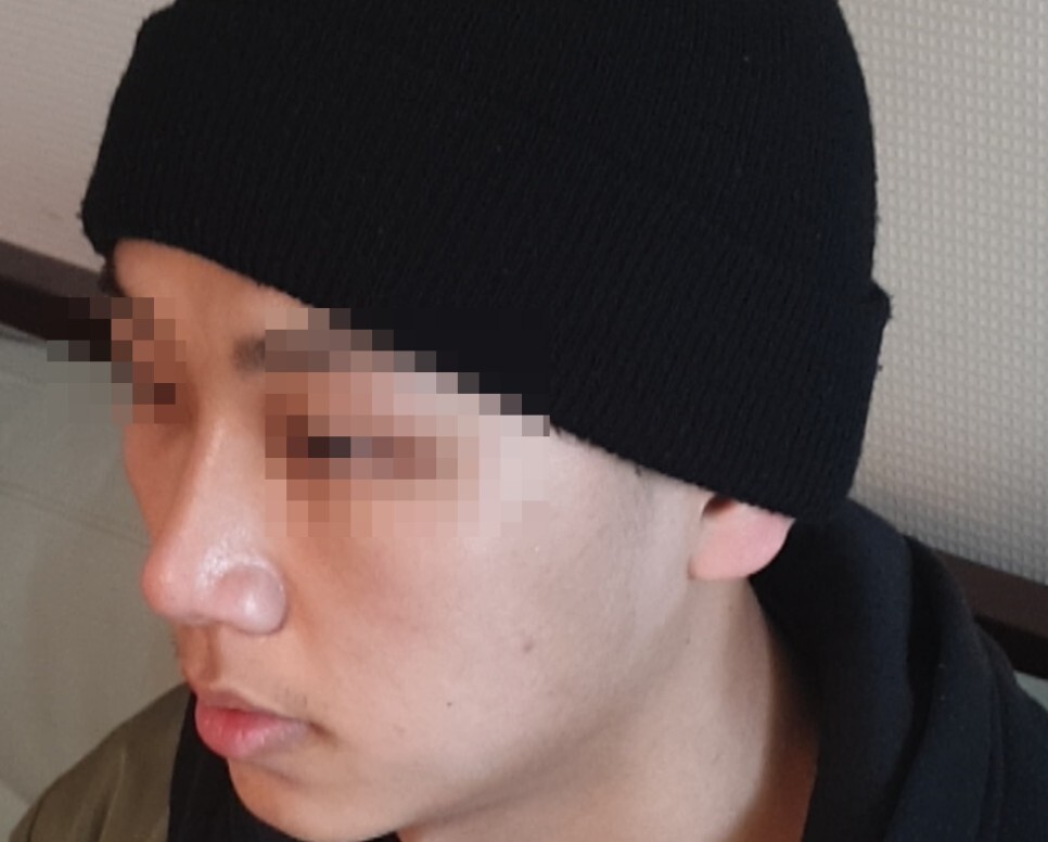 비중격 만곡증 수술 후기