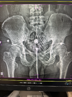 바지를 환복 하지않고 찍어 엑스레이 영상에 아티팩트가 발생한 사례