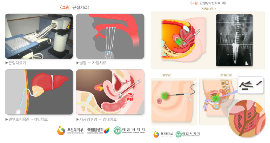 암 방사능 치료