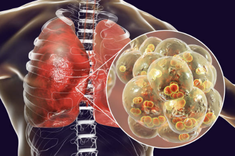 폐렴구균 예방접종 횟수 비용 무료 접종후 주의사항 총정리