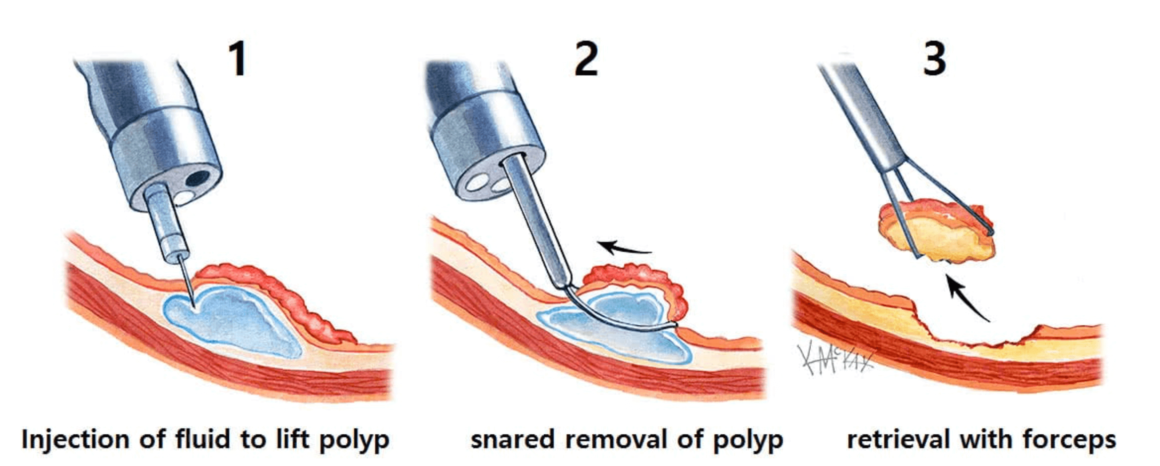대장내시경-용종제거-방법