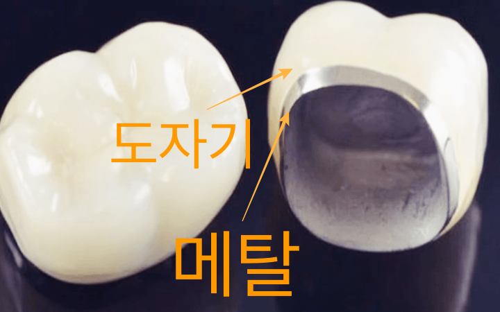 겉은-도자기-속은-메탈인-PFM