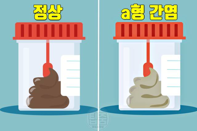 a형간염 증상 원인 회색 하얀색 변